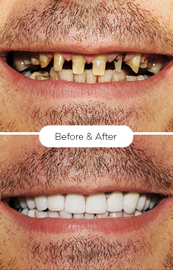 Dental Implants San Diego | We Help Our Patients Smile Again