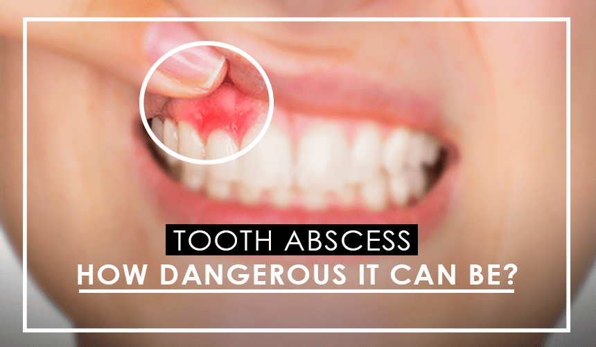 34-what-causes-abscesses-in-teeth-gif-teeth-walls-collection-for