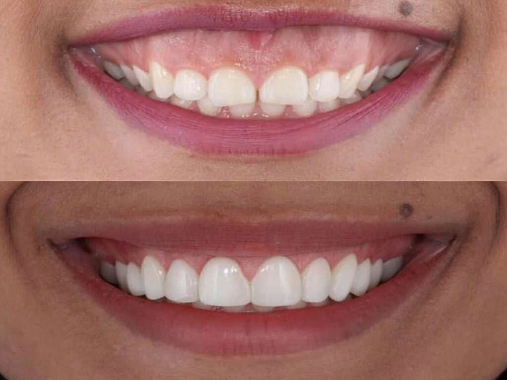Cosmetic Gum Contouring Living With A ‘gummy Smile Top Cosmetic Dentist In San Diego