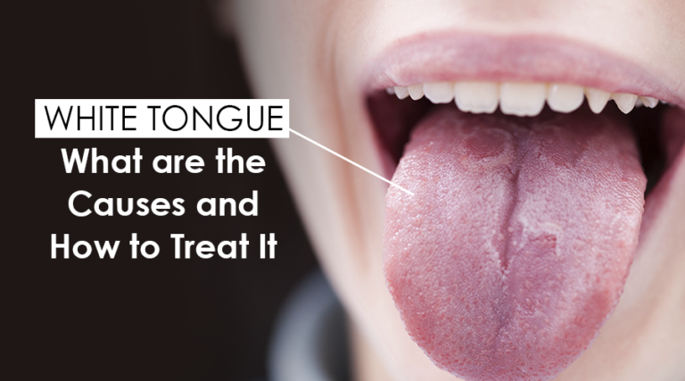 White Tongue: What Are The Causes And How To Treat It » Top Cosmetic ...