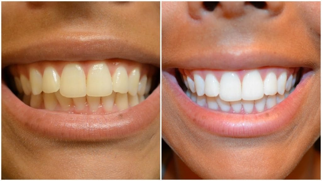 Professional Teeth Whitening San Diego