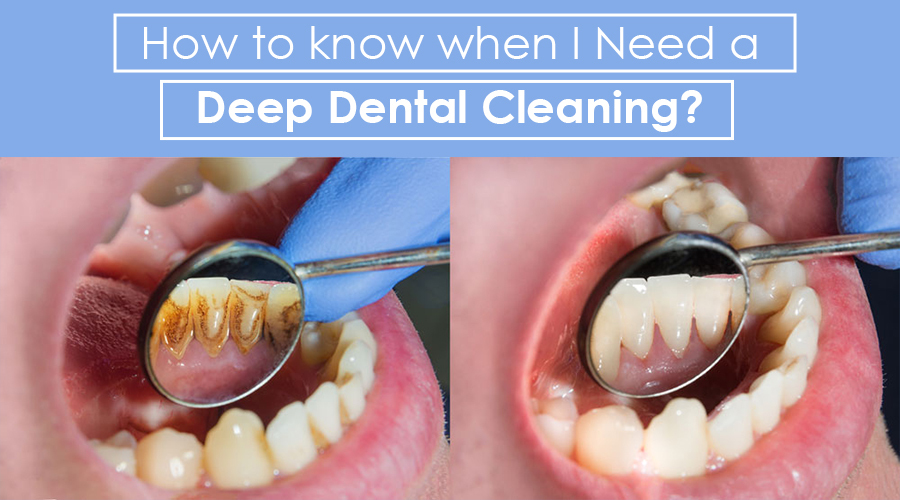 Deep Cleaning: How do I know if I need this treatment?