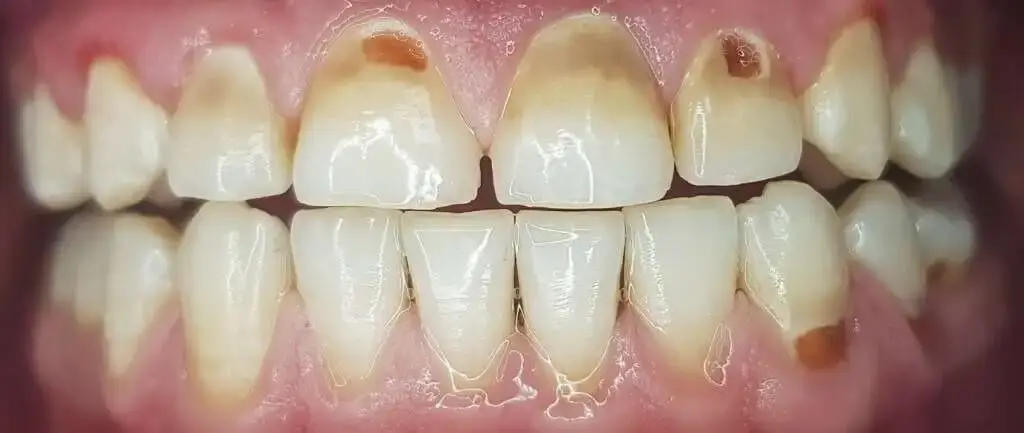 A close-up of teeth with dental erosion.