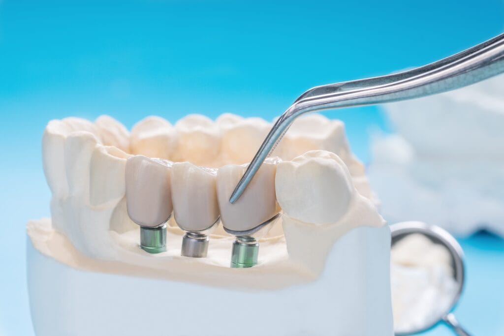 dental implants in san diego