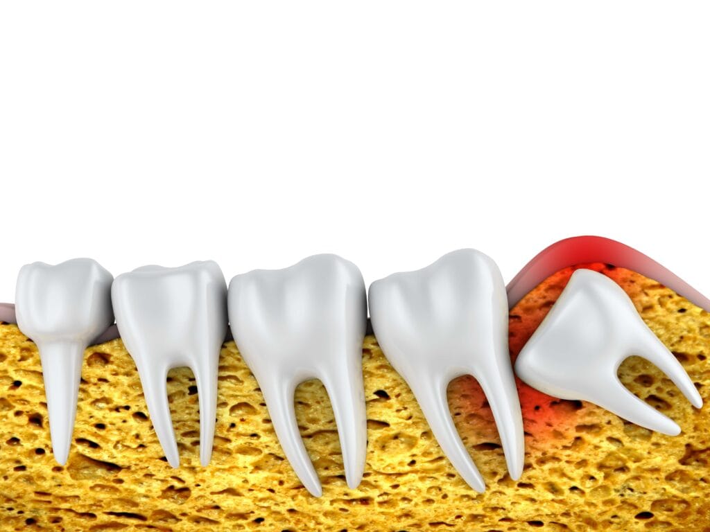 impacted wisdom teeth