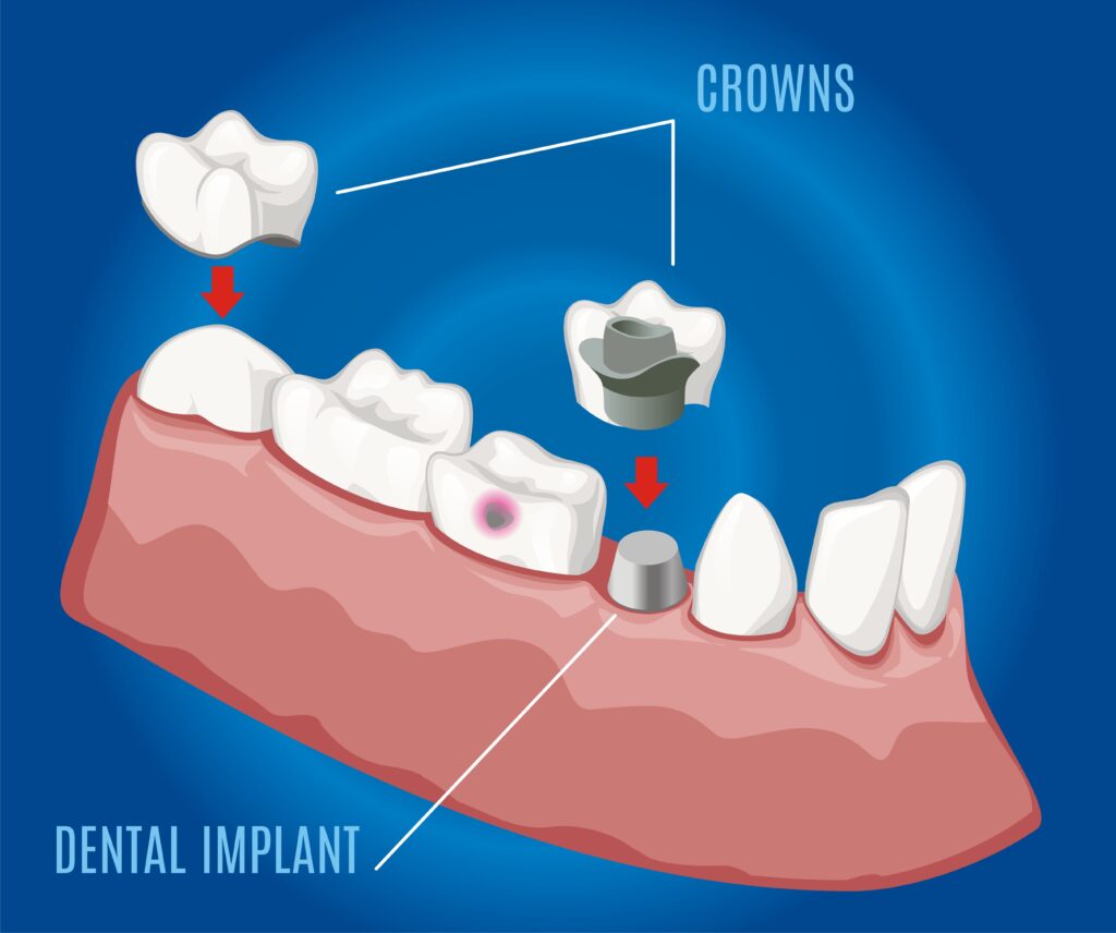 dental crown