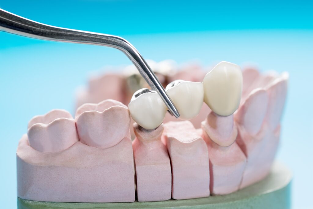 dental bridges in San Diego