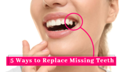 5 ways to replace missing teeth