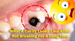 What Does A Cavity Look Like? Cavity Symptoms You Should Never Ignore