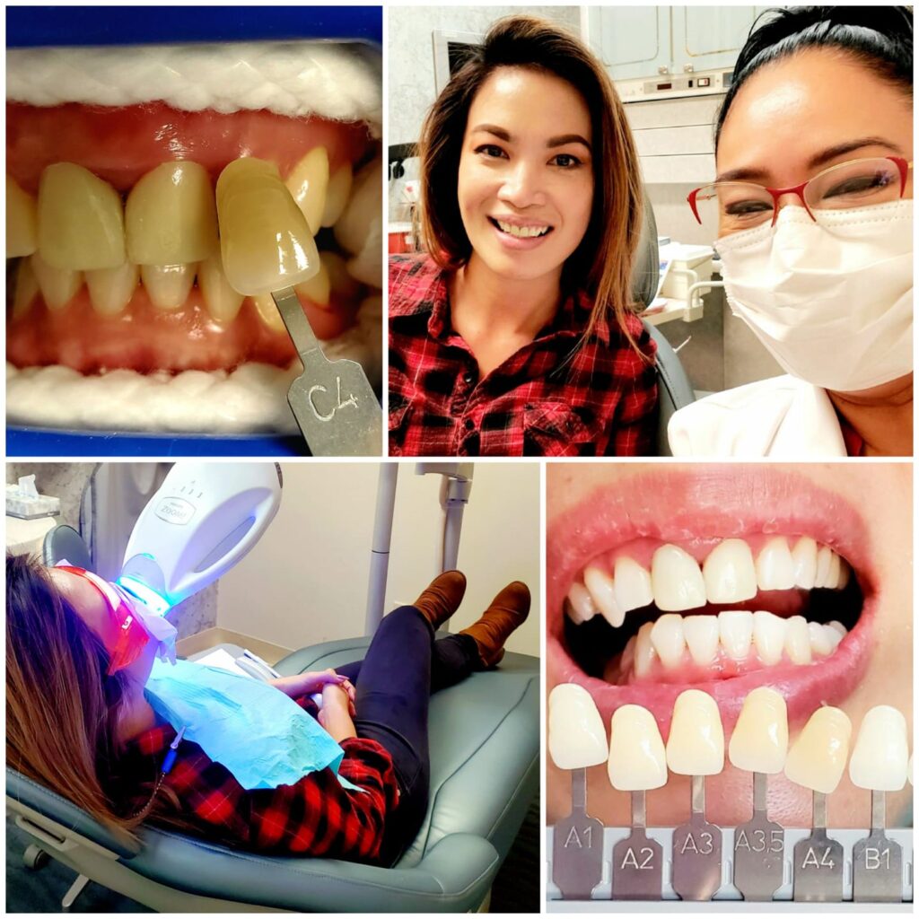 teeth whitening in San Diego