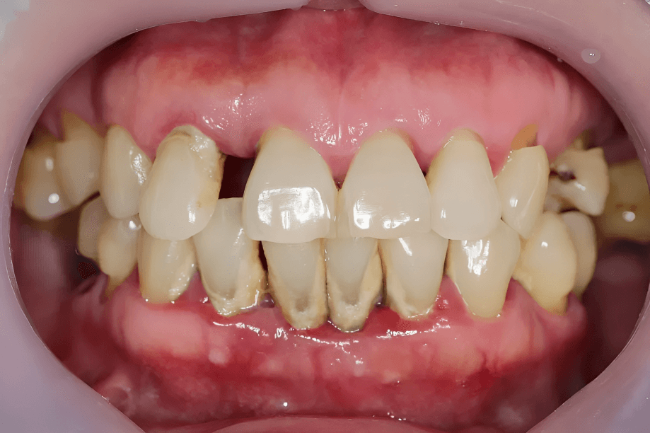  Close-up of a mouth showing signs of chronic periodontal disease.