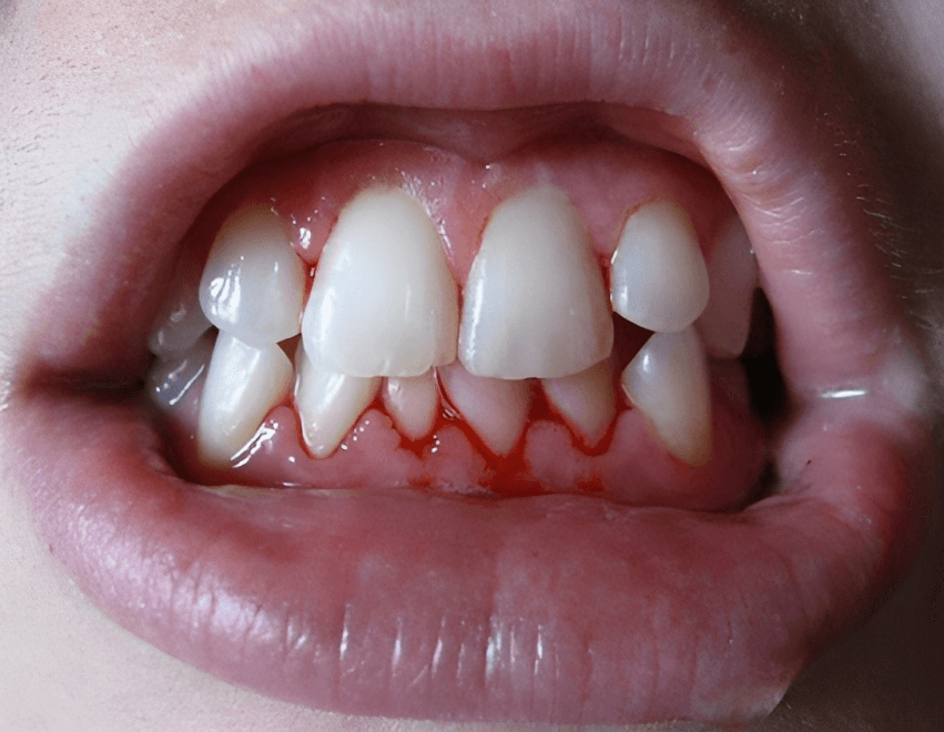  Close-up photo of a mouth with gingivitis.