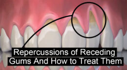 How Receding Gums Can Affect Your Teeth