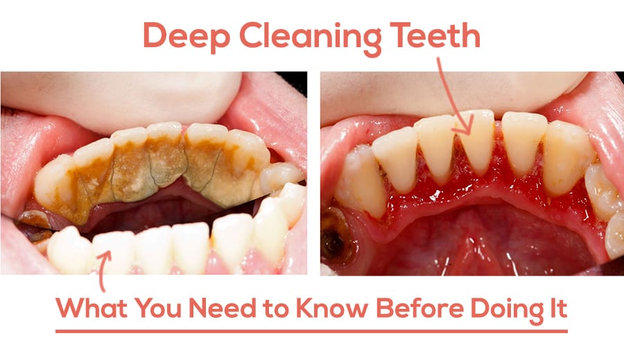 Deep Dental Cleaning 7 Surprising Benefits You Never Knew Top   Serena What You Need To Know Before Doing It 