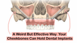 weird but effective way your cheekbones can hold dental implants