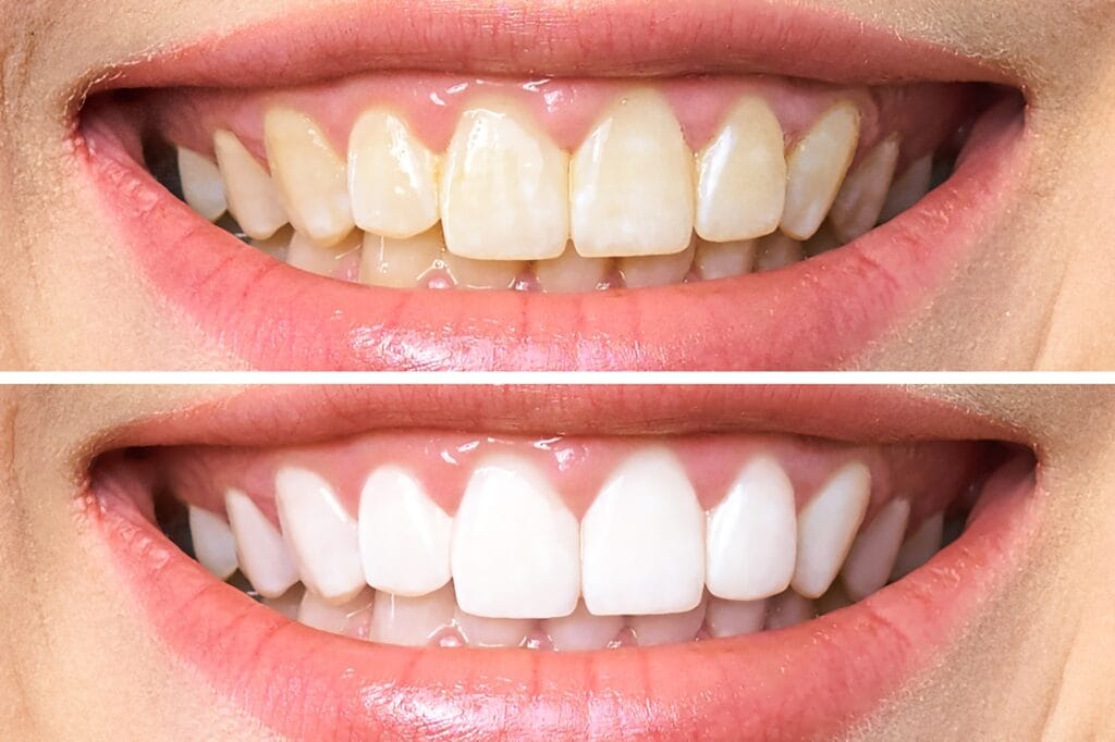 before and after teeth whitening