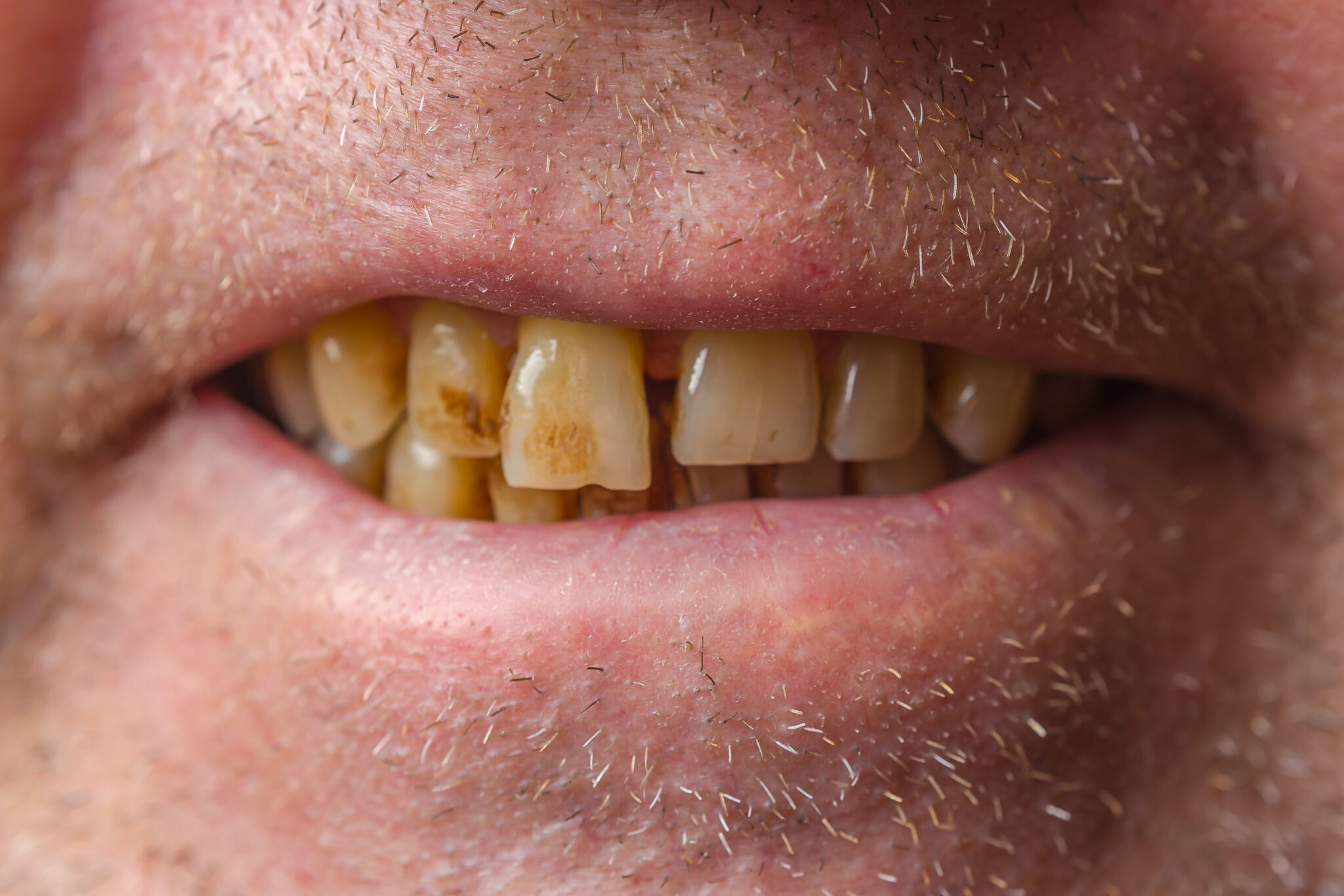 9-foods-that-are-surprisingly-bad-for-your-teeth-spry-living