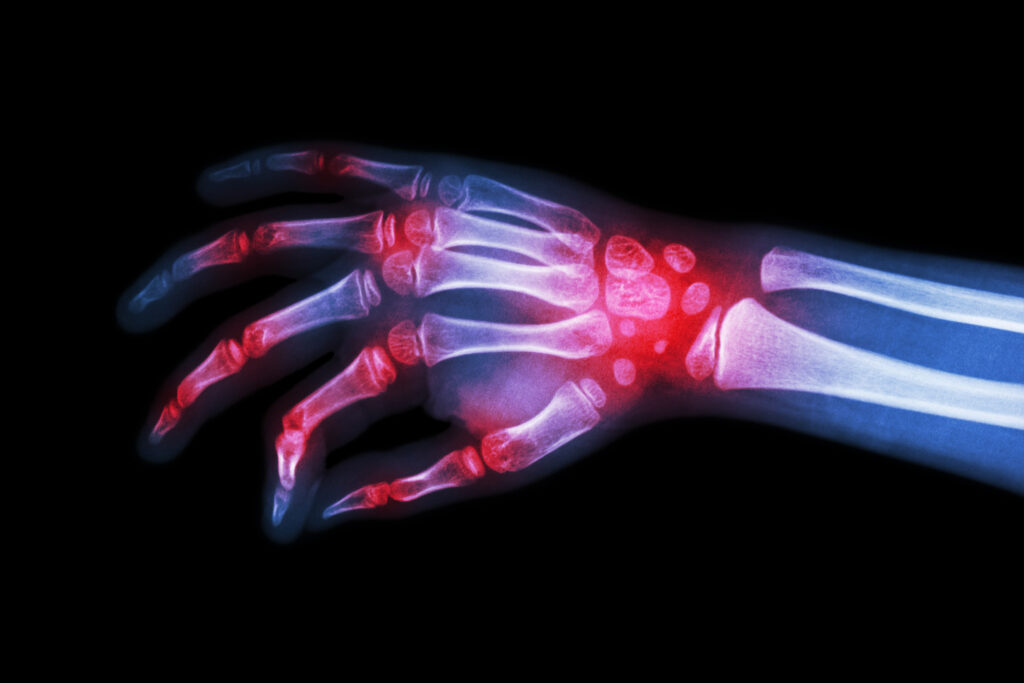 Rheumatoid Arthritis 1