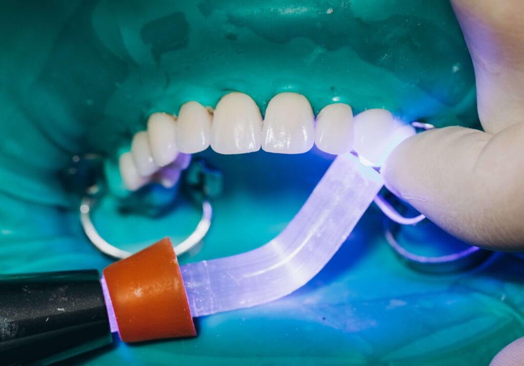 placing porcelain veneers