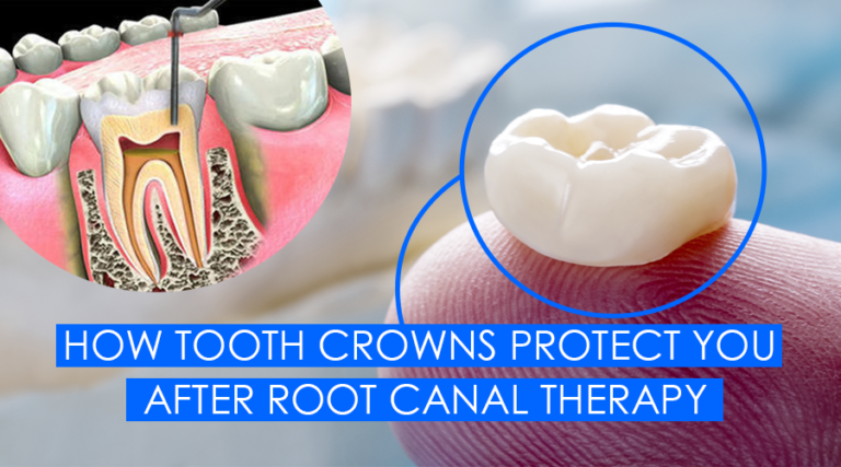 Root Canal Therapy: What Tooth Crowns Can Do For You After This ...