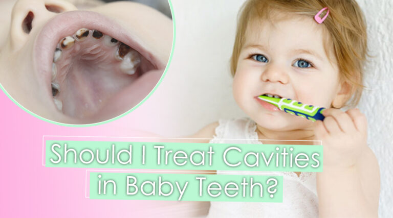 Should You Treat Cavities In Baby Teeth? » Top Cosmetic Dentist In San ...