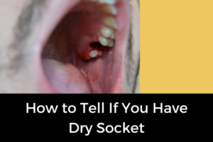 What Is A Dry Socket & When Can I Stop Worrying About It? » Top ...