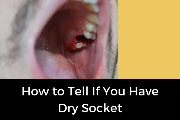 When Can I Stop Worrying About a Dry Socket? Causes & Symptoms