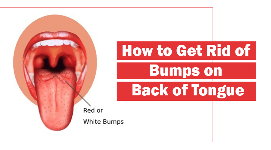 Big Bumps On The Back Of My Tongue