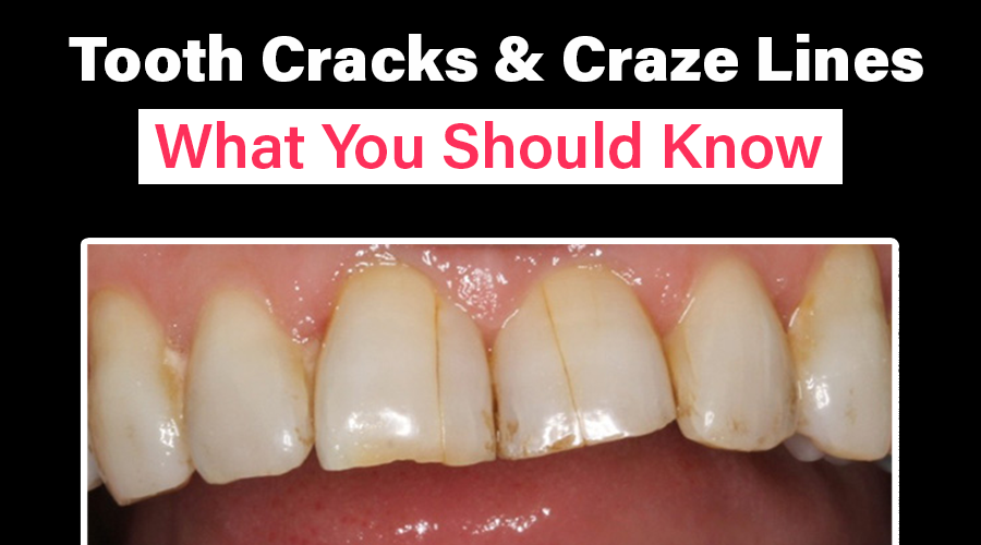 What Are Teeth Craze Lines? Treatment, Causes & Prevention - Tooth