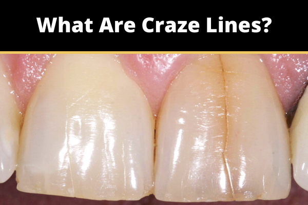 What Are Craze Lines?  Oakville Place Dental