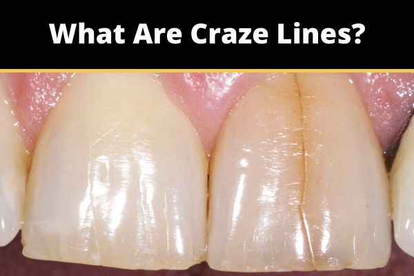 Tooth Cracks & Craze Lines: Here What You Should Know » Top