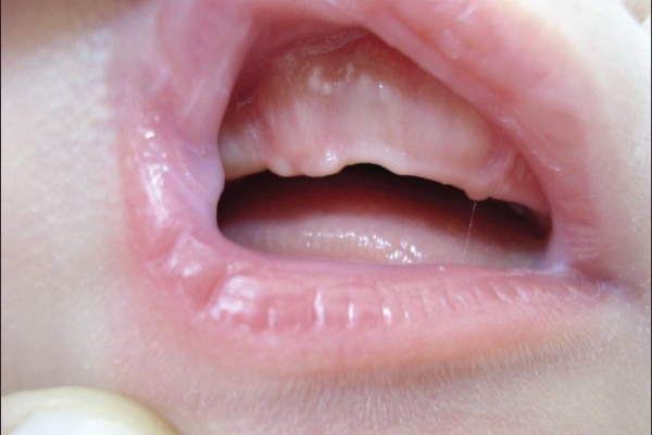 Little White Bumps What Causes Gingival Cysts In Babies Top