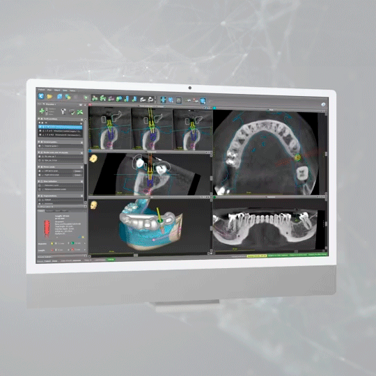 AI 3D Implant Software 1