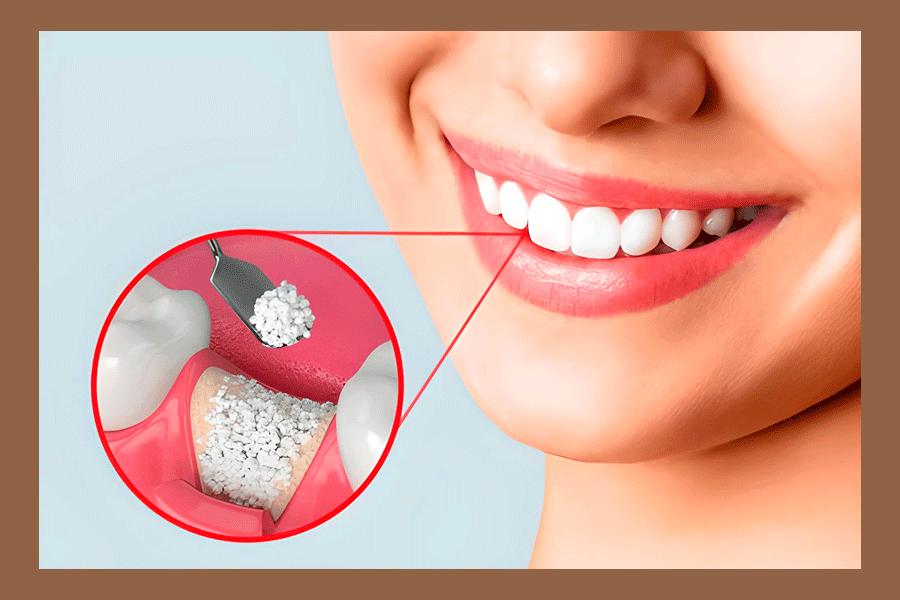 An infographic showing the bone graft process from start to finish.