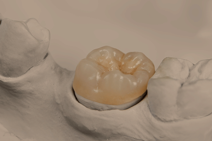 Dental Crown