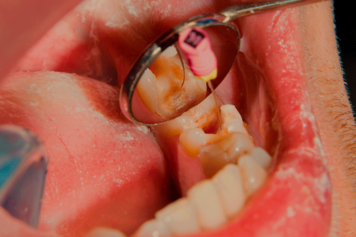 Root Canal