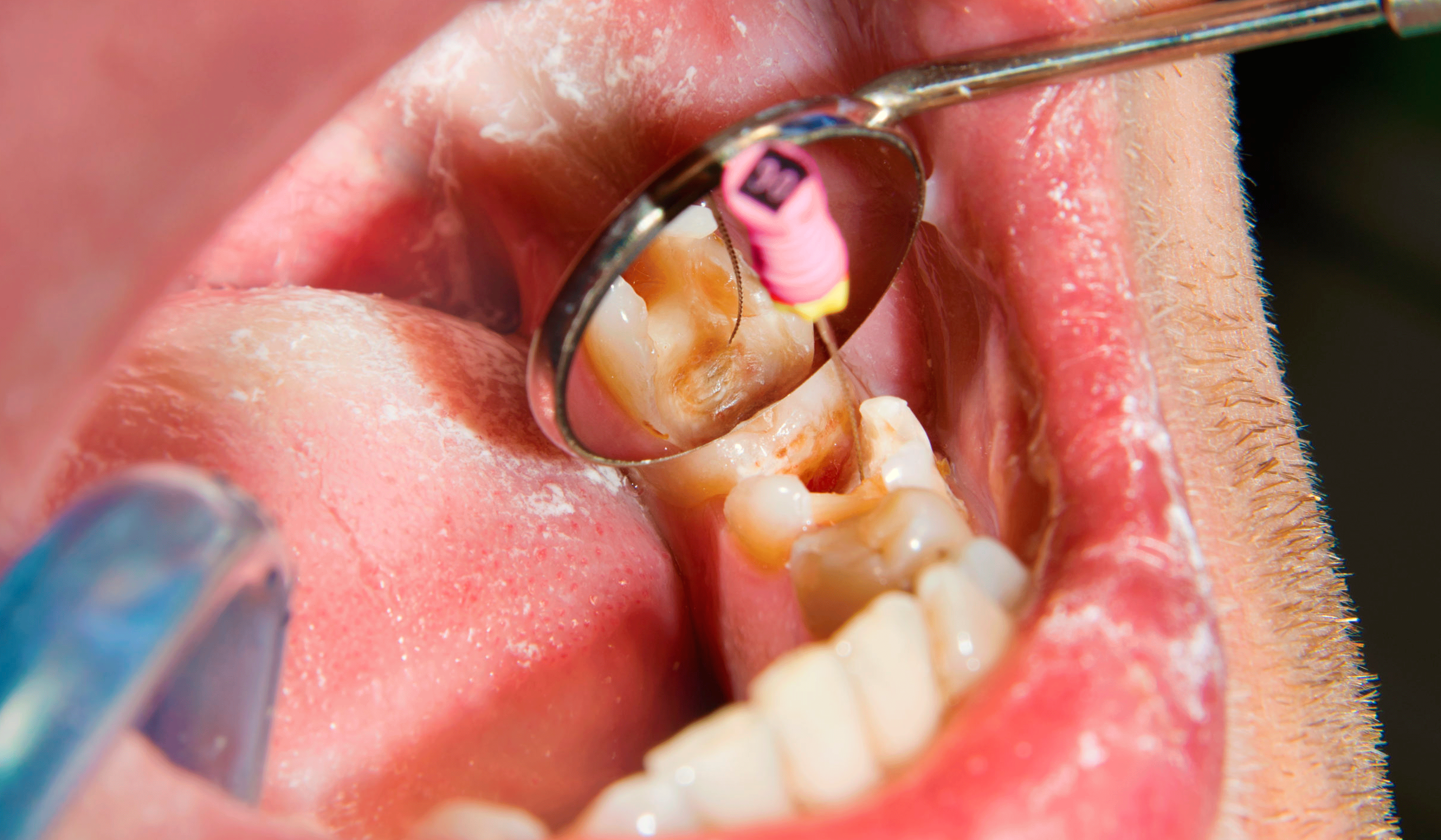 A realistic photo depicting a tooth with a cavity and the initial stage of a root canal procedure at Serena Dental.