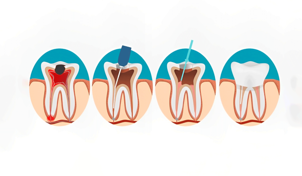 A series of images depicting the step-by-step root canal process at Serena Dental.