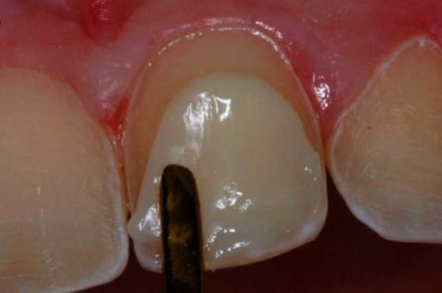 Composite Veneers Procedure