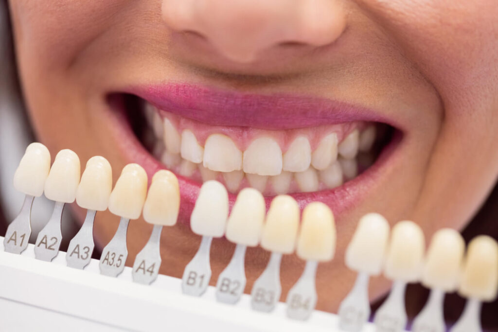 Porcelain Veneers An image showcasing a dentist holding a dental shade guide for selecting veneer colors.