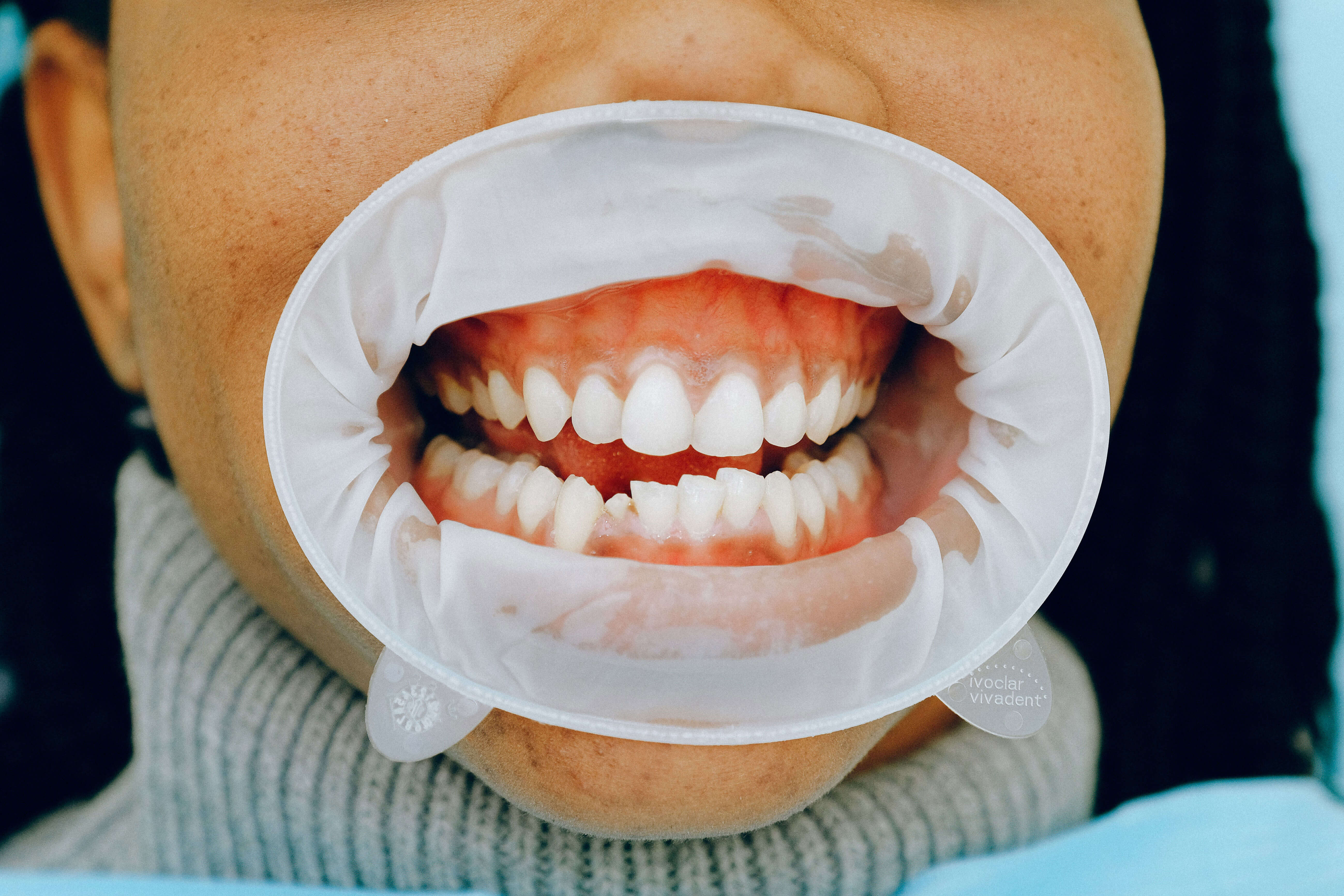 Photograph Cracked Tooth Woman with Broken Tooth