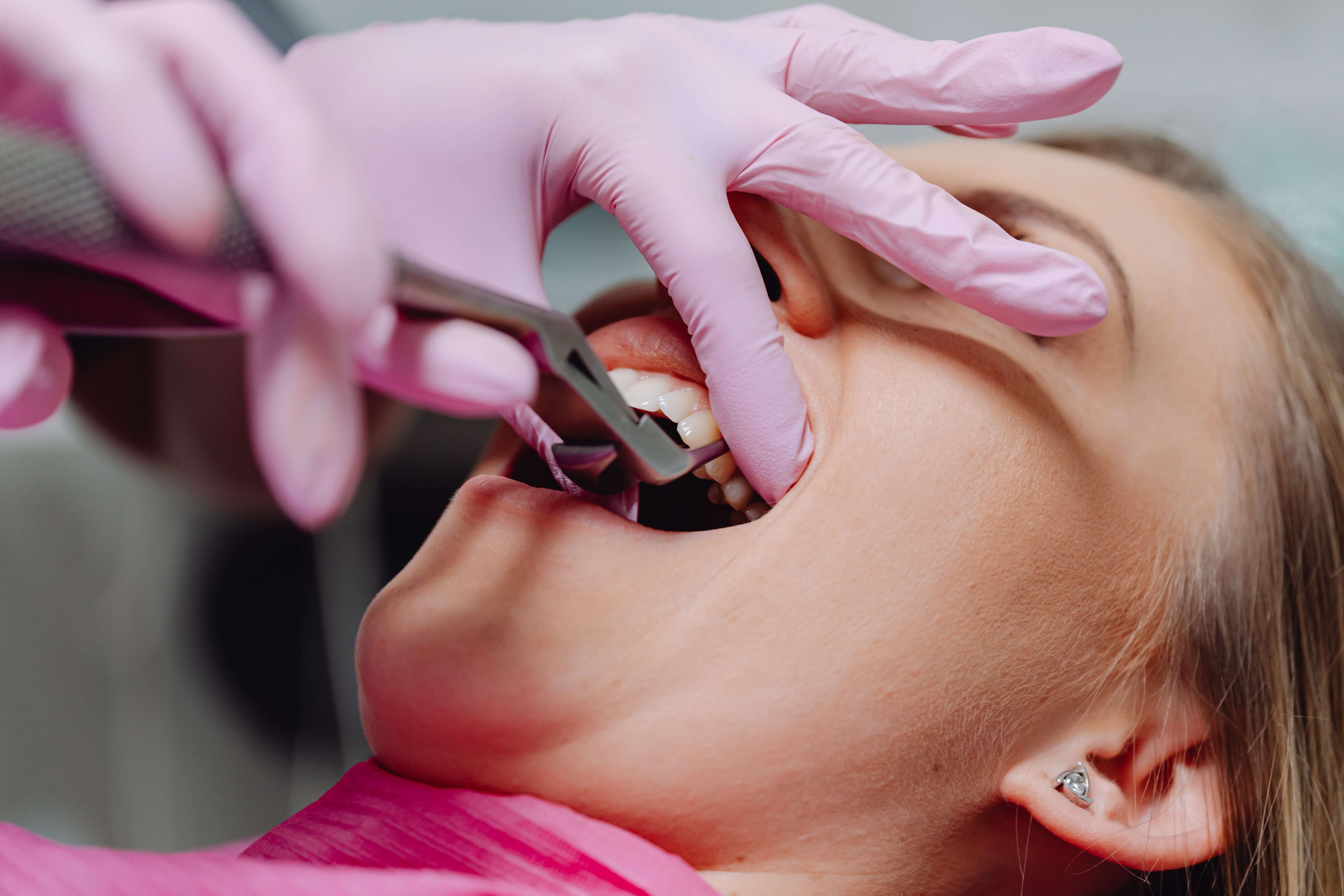 Photograph Knocked Out Tooth