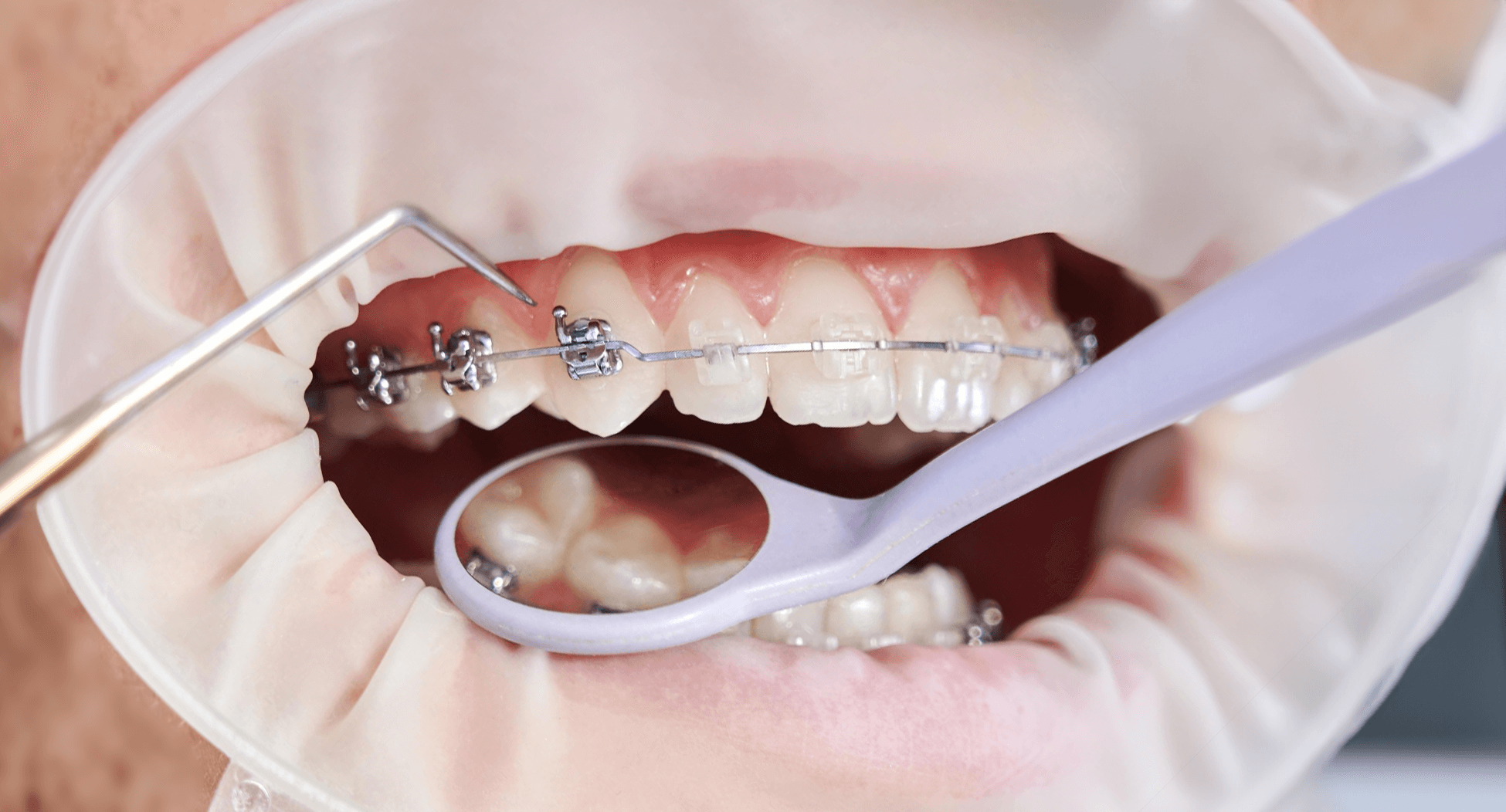 An image showcasing the step-by-step process of Six Month Smiles treatment.