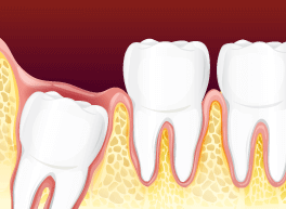  Graphic of the Interior of a Wisdom Tooth