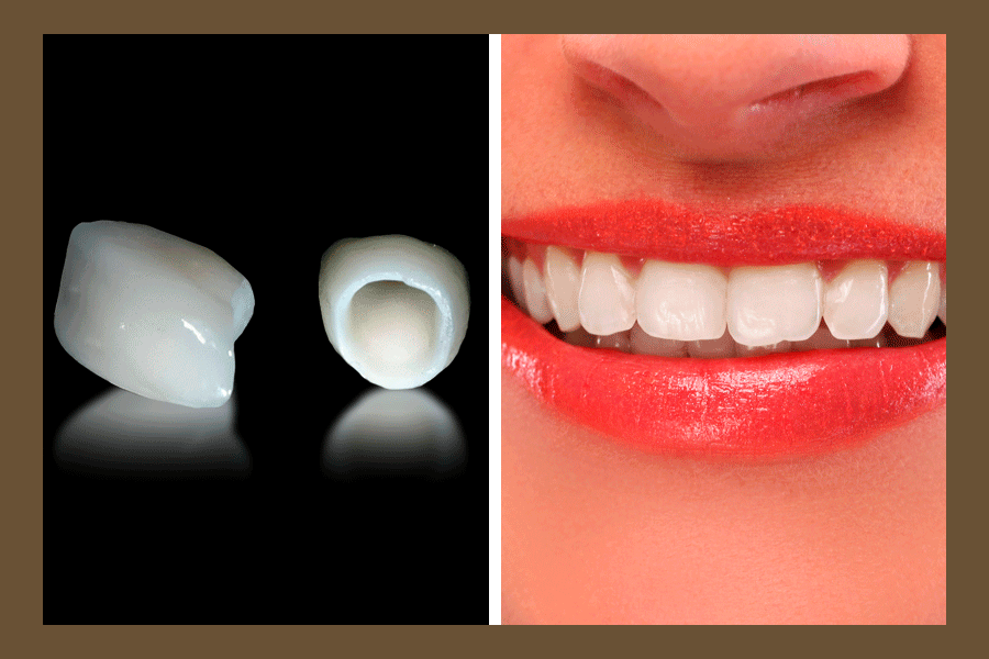 A stunning image of a perfect smile, contrasting with an X-ray image showing a loose e-max implant.