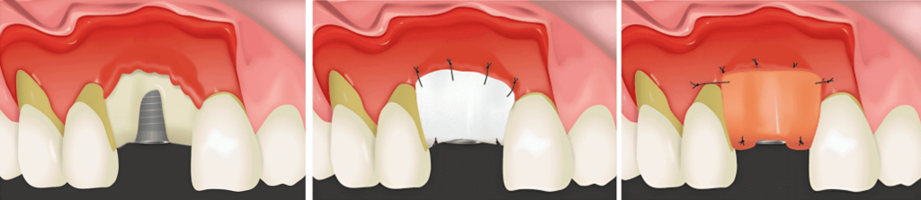 Bone Graft Process with Dental Membrane Application 1