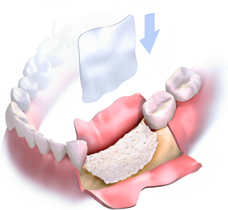 Bone Grafting in Oral Surgery