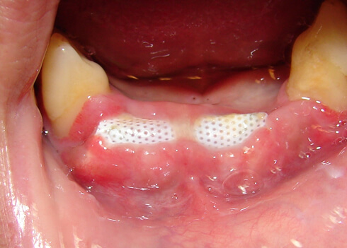 Dental Membrane in Bone Grafting