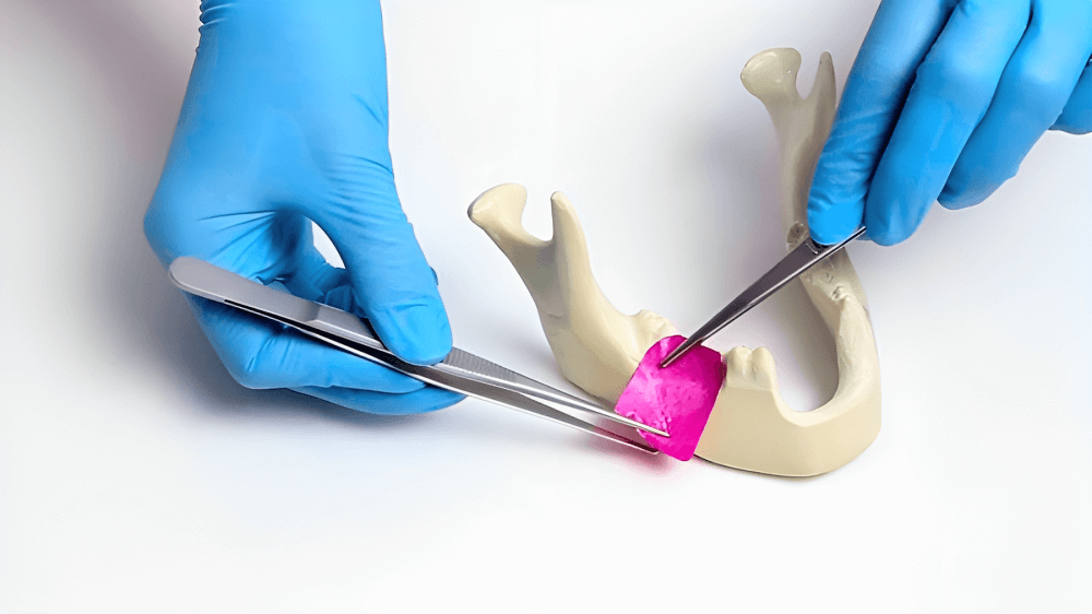 Placing a Dental Membrane in Mandibular Reconstruction 1