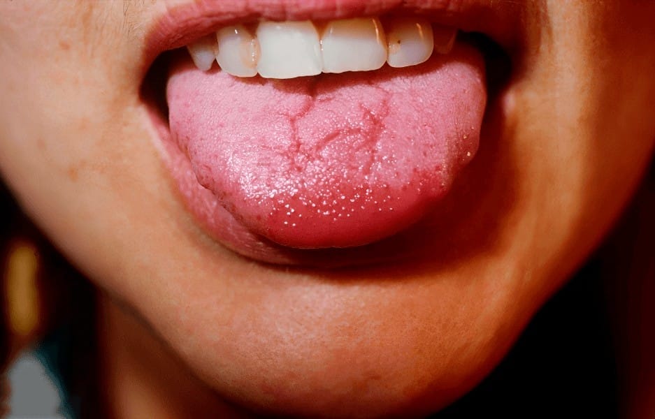 Decoding Tongue Bumps Uncover The Truth 7 Vital Tips